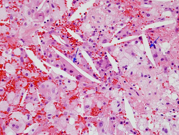 7A2 Cholesterol clefts (Case 2) H&E 2