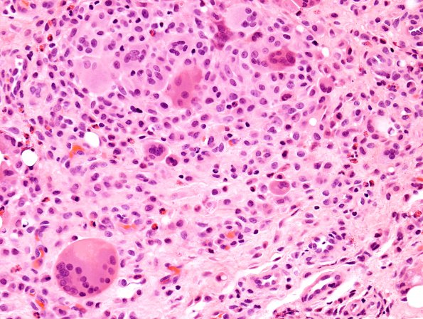 8A1 Fat Necrosis, histiocytic rxn (Case 3) H&E 1