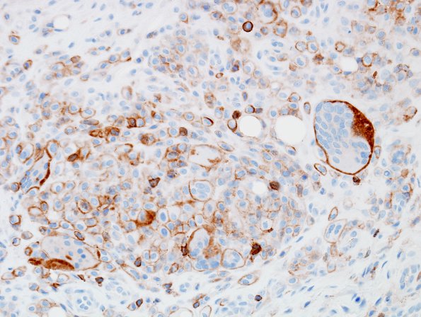 8A2 Fat Necrosis, histiocytic rxn (Case 3) CD45 2