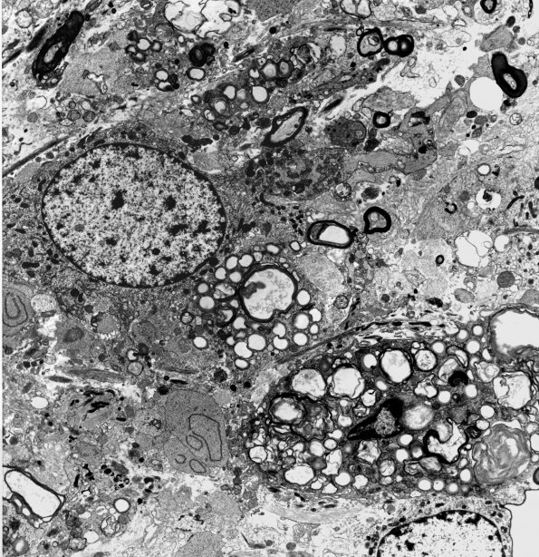 9 Macrophages EM (WUMS Case) - Copy