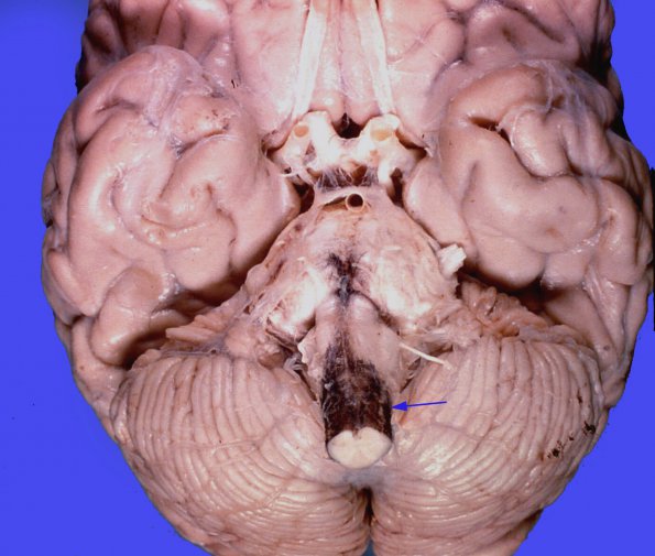 1A1 Melanocytes, leptomeninges