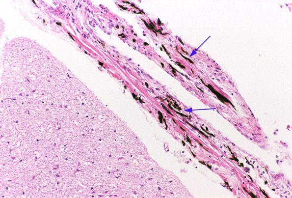 1A2 Melanocytes, leptomeninges 2