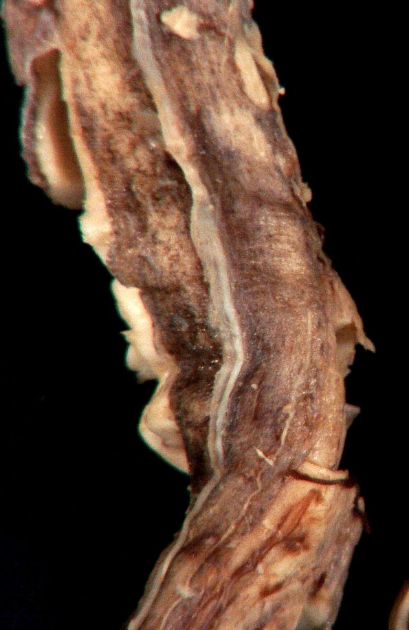 2A2 Melanosis, leptomeningeal (Case 1) 3