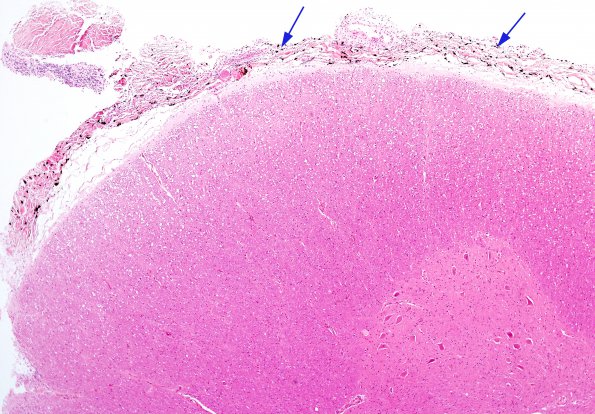 2A3 Melanosis, leptomeningeal (Case 1) H&E 1