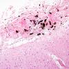 2A4 Melanosis, leptomeningeal (Case 1) H&E 3