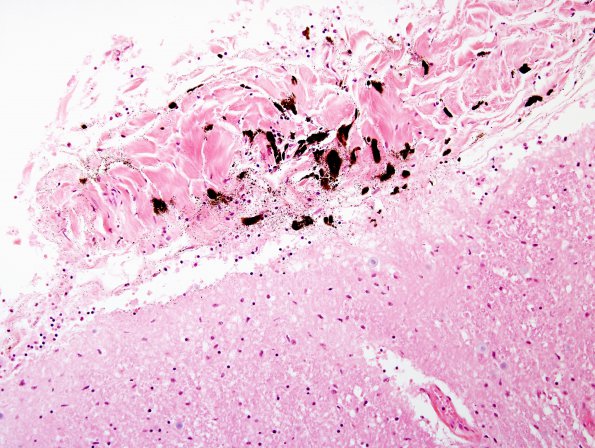 2A4 Melanosis, leptomeningeal (Case 1) H&E 3