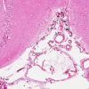 3A1 Melanosis, leptomeninges (Case 2) H&E 1