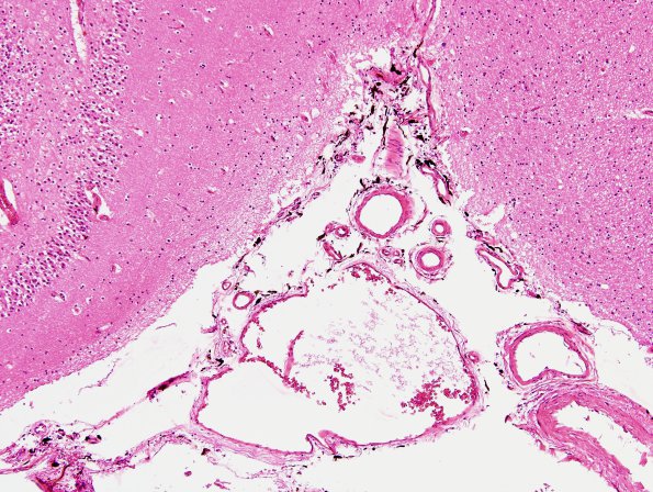 3A1 Melanosis, leptomeninges (Case 2) H&E 1