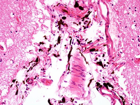 7 Melanosis, leptomeninges (Case 2) H&E 3