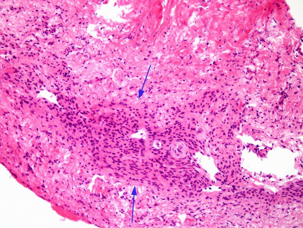 1A1 Arachnoidal cap cell hyperplasia (Case 1) 1 H&E.