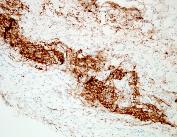 1A2 Arachnoidal cap cell hyperplasia (Case 1) 2 EMA