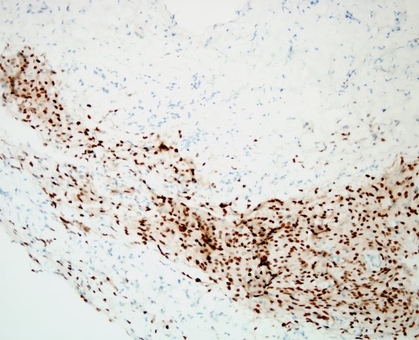 1A3 Arachnoidal cap cell hyperplasia (Case 1) 3 PR