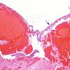 1A4 Meningothelial hyperplasia (Case 1) H&E 2