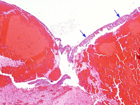 1A4 Meningothelial hyperplasia (Case 1) H&E 2