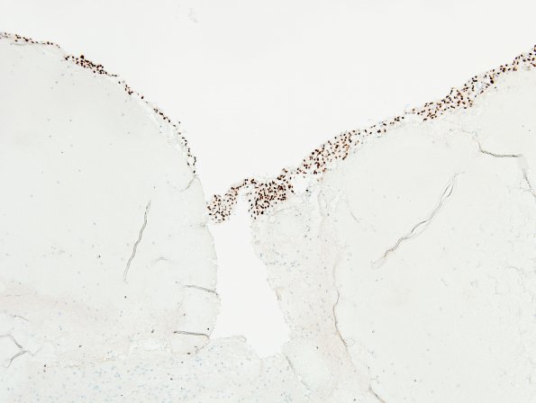 1A5 Meningothelial hyperplasia (Case 1) PR 1