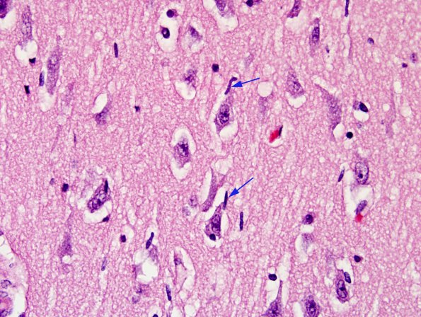 10 Microglia, early neuronophagia (Case 4) H&E 1