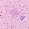 11A1 Microglia (Case 11) H&E N4 20X