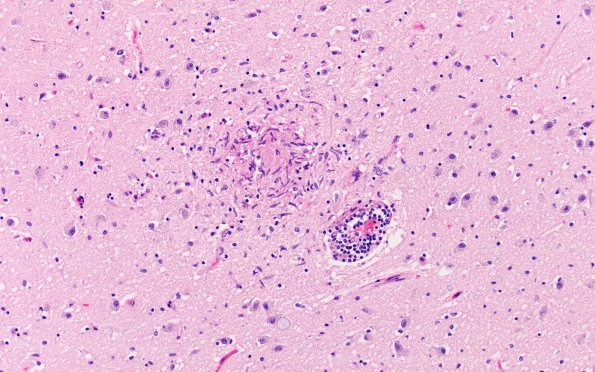 11A1 Microglia (Case 11) H&E N4 20X