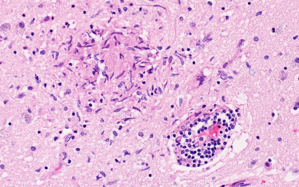 11A2 Microglia (Case 11) H&E N4 40X