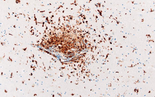 11B1 Microglia (Case 11) CD68 N4 20X