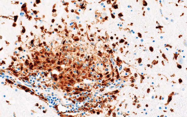 11B2 Microglia (Case 11) CD68 N4 40X