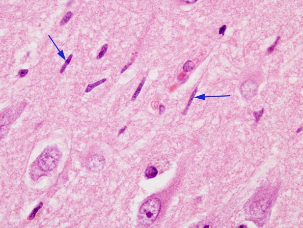 2A1 Microglia, rod cells (Case 7) H&E 2