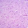 2A2 Microglia, rod cells (Case 7) LFB-PAS 3