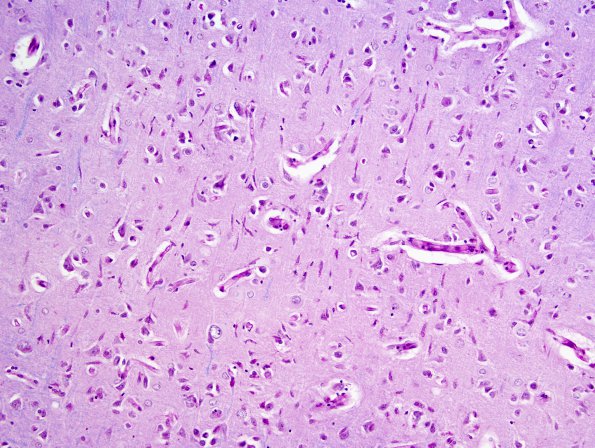 2A2 Microglia, rod cells (Case 7) LFB-PAS 3