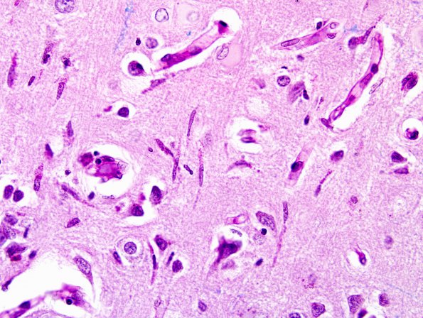 2A3 Microglia, rod cells (Case 7) LFB-PAS 5A