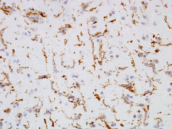 3 Microglia (Case 1) CD68