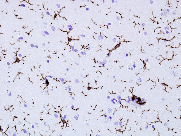 4A1 Microglia (Case 2) CD45 1