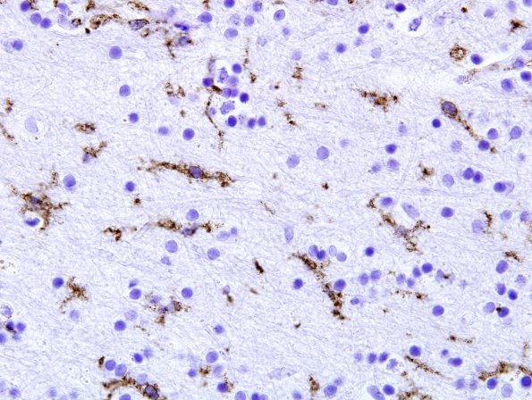 4A2 Microglia (Case 2) CD45 4