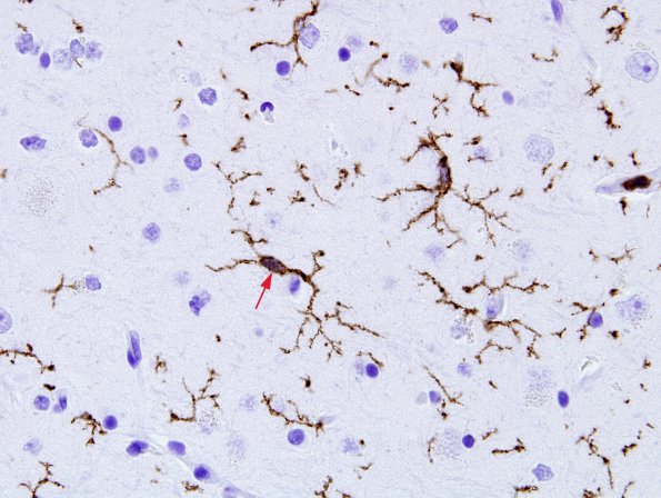 4A3 Microglia (Case 2) CD45 2