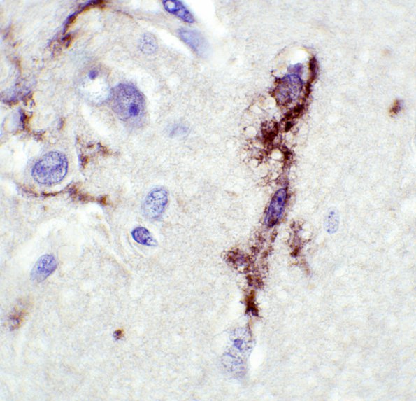 6 Rasmussen's Encephalitis (Case 6) LCA 3