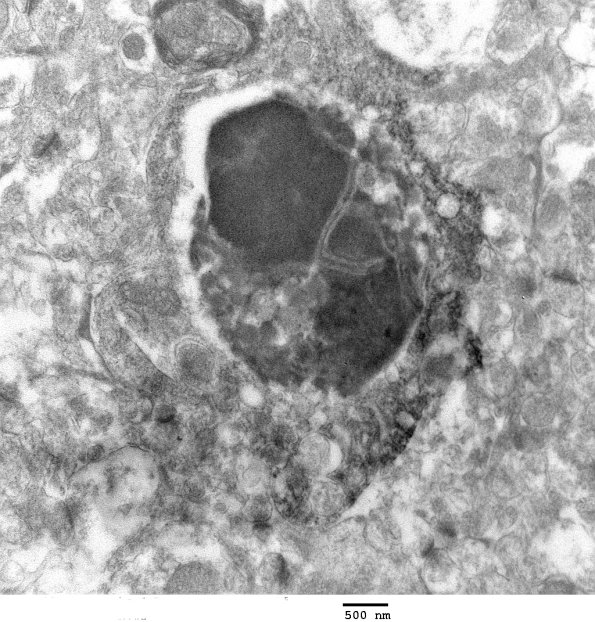 7A4 Neuronophagia, microglia West Nile Virus Iba-1 ImmunoEM 015