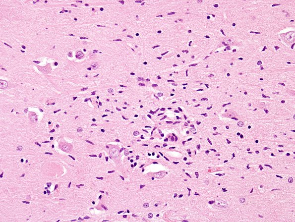 8 Microglia, nodule (Case 5) H&E 1