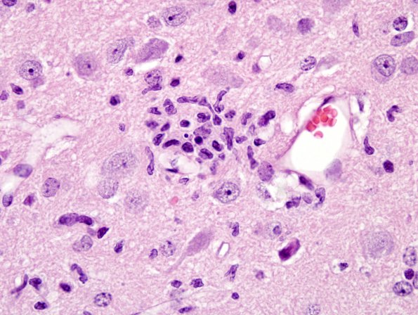 9A1 Microglial nodule vs neuronophagia, Virus 8