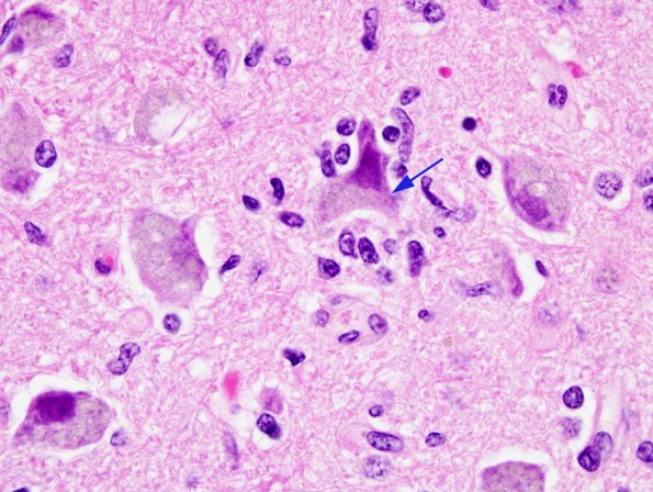 9A2 Microglia, Neuronophagia H&E 2