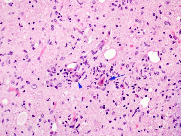 9A3 Microglia, Neuronophagia H&E 4