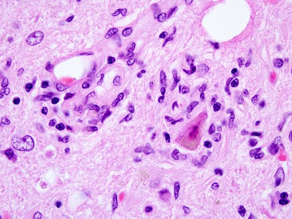 9A4 Microglia, Neuronophagia H&E 5