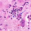 9A5 Microglia, neuronophagia, paraneoplastic HC, H&E 6