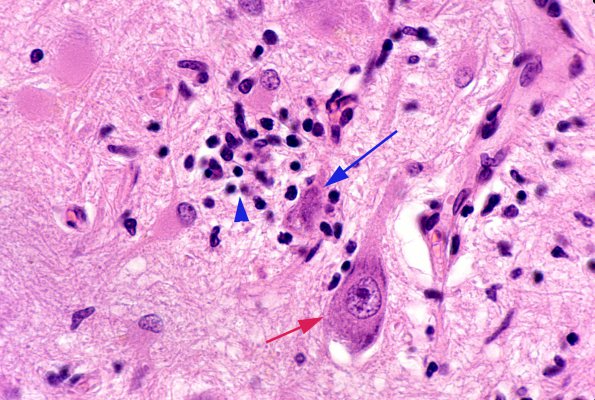 9A5 Microglia, neuronophagia, paraneoplastic HC, H&E 6