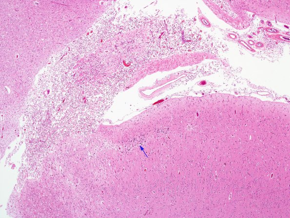 1A1 Neurons, mineralized edge Bx cavity (Case 4) H&E 1