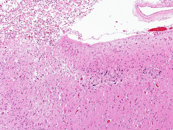 1A2 Neurons, mineralized edge Bx cavity (Case 4) H&E 2