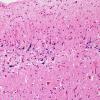 1A3 Neurons, mineralized edge Bx cavity (Case 4) H&E 4