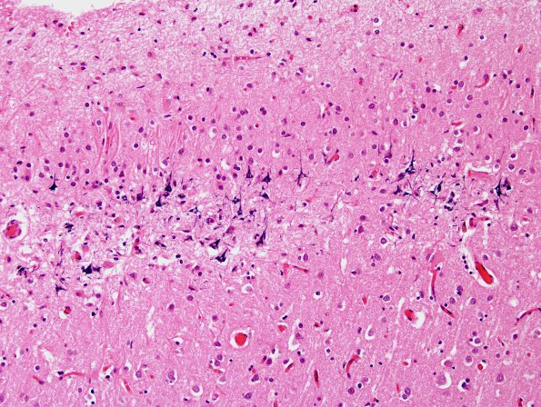 1A3 Neurons, mineralized edge Bx cavity (Case 4) H&E 4