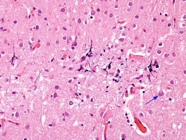 1A4 Neurons, mineralized edge Bx cavity (Case 4) H&E 3