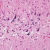 1A5 Neurons, mineralized edge Bx cavity (Case 4) H&E 5