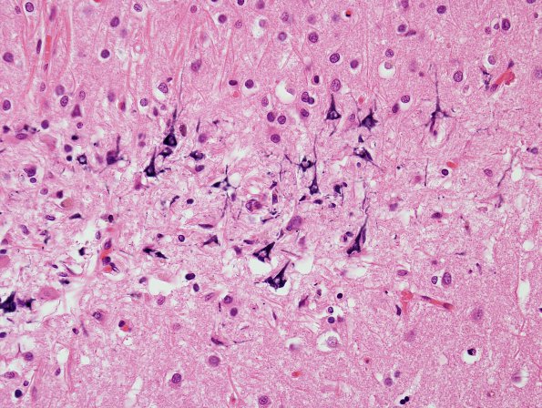 1A5 Neurons, mineralized edge Bx cavity (Case 4) H&E 5