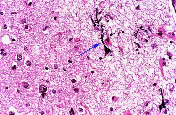 2 Neuron, Mineralization